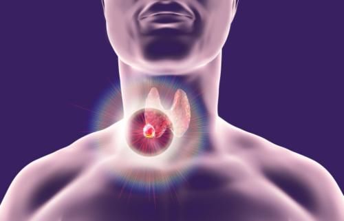 银耳|甲状腺结节不能喝豆浆？提醒提醒：若想甲功正常，3种食物要少吃