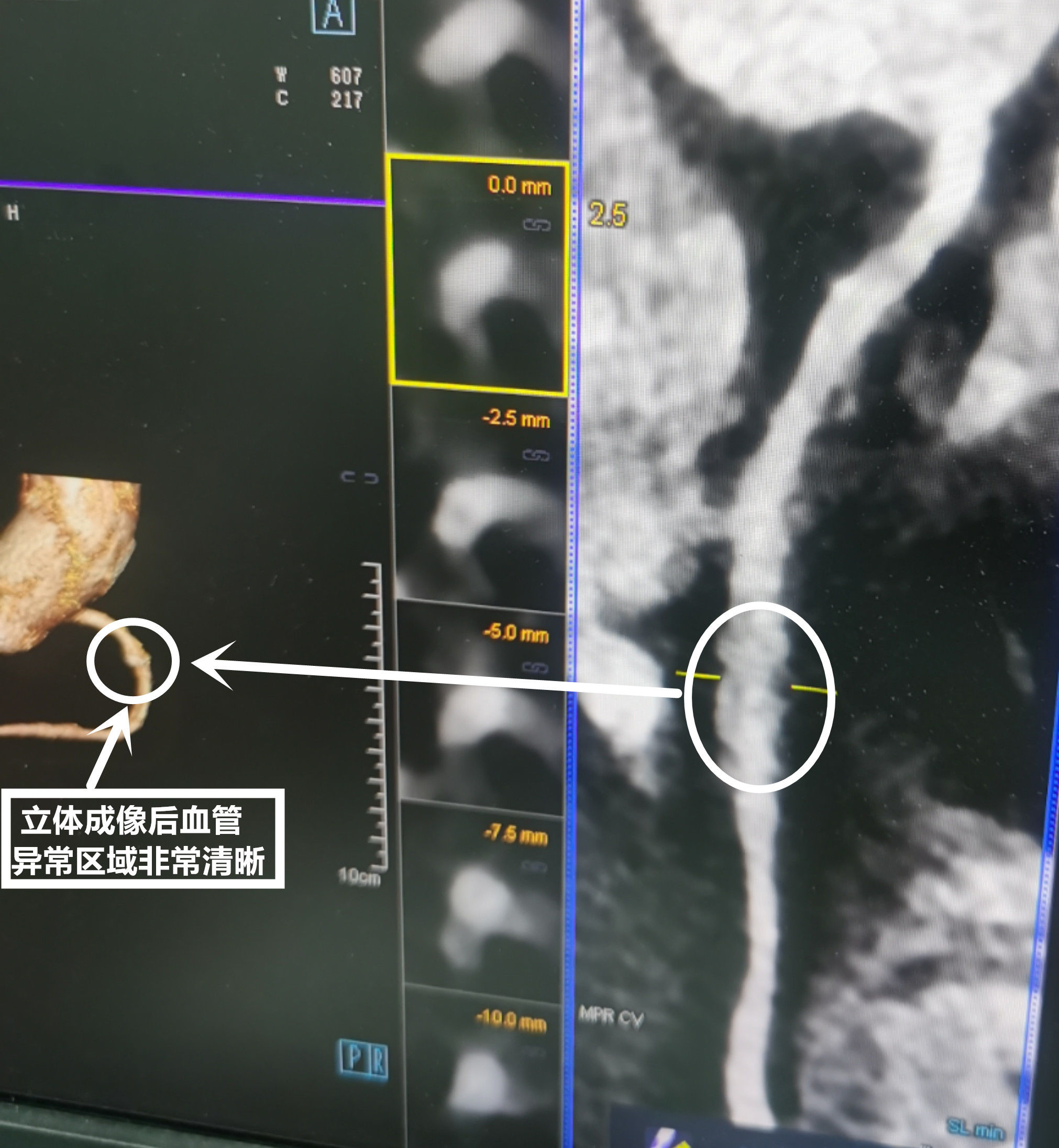 肺科医院|能“解”痛风结晶，会“算”血管狭窄，武汉市肺科医院引入会解方程的双源CT