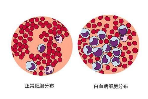 甜味素|为什么白血病喜欢挑儿童“下手”？原因已找到，为了孩子要了解下