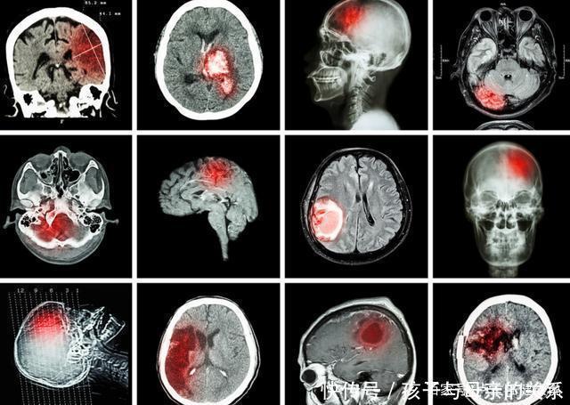 炒菜|80后夫妻相继脑梗入院，医生提醒：与炒菜爱放1物有关，劝你少吃