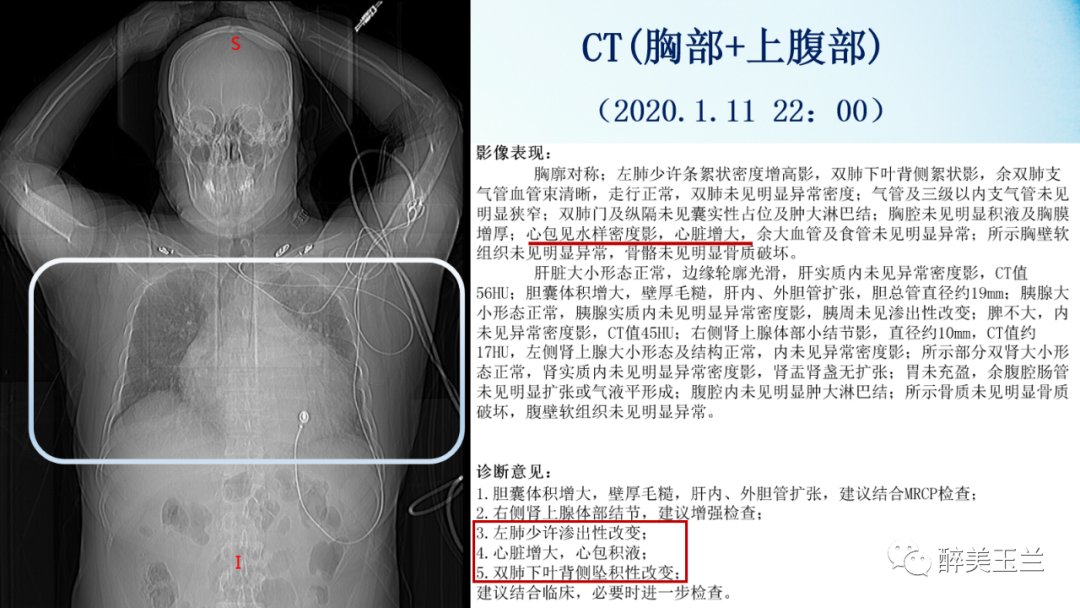 扩张型心肌病患者非心脏手术的全身麻醉一例|病例讨论 | 全身麻醉