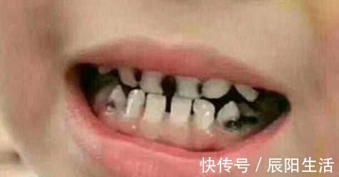 甜食|4岁宝宝坚持刷牙,半年后却满嘴“小黑牙”,父母无知多可怕