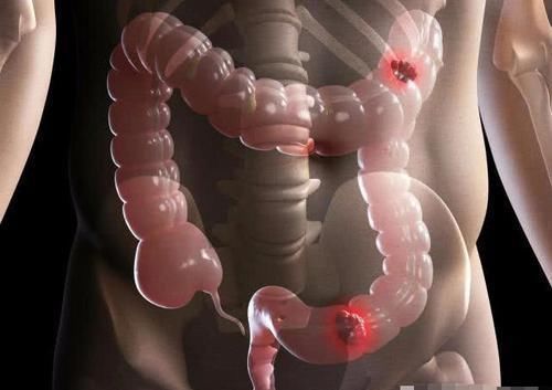 大便“前硬后软”祸首终于弄清楚了,做好5件事,肠道感激你