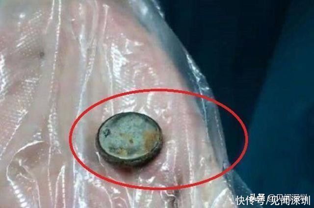 不良习惯|深圳8岁小女孩，经常腹痛食欲不振，医生发现她竟在吃这东西