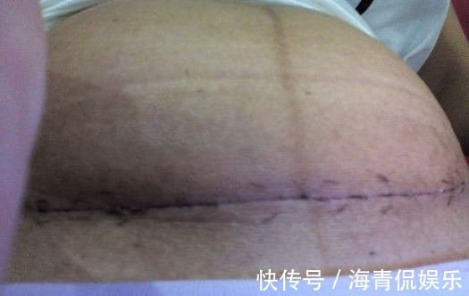 检查|女子剖腹产三个月伤口冒水,医生检查伤口,不淡定