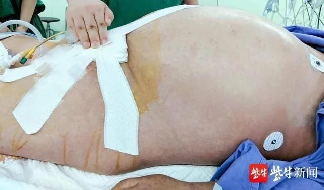 胰腺炎患者腹部压力增大，使得肚子瞬间胀大