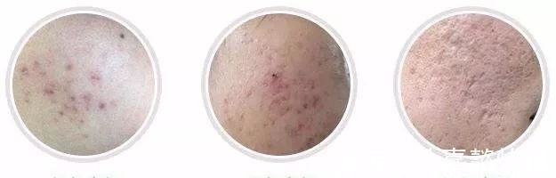 化学型 小心!以下5个护肤坏习惯,能让你的毛孔越来越大……