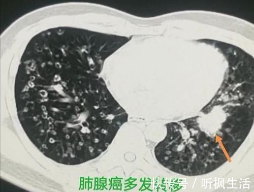 肺癌|肺癌最早爱往哪些部位转移?转移了还有救吗?