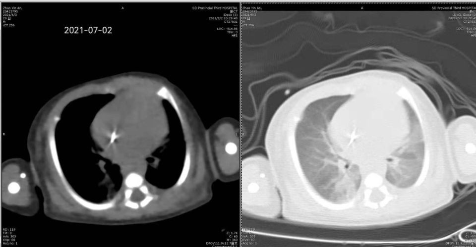 危重症|32天早产危重症患儿实施纤维支气管镜检查治疗