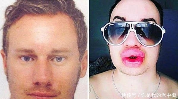 32岁男子花4万多做丰唇手术,结果像挂了两根香肠