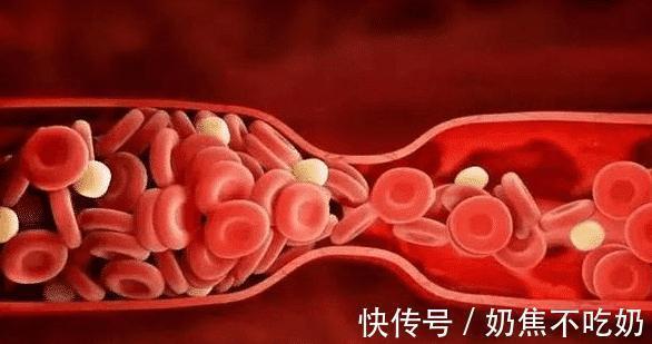 降血脂|每天跑步可以降血脂?提醒:远离这3种蔬菜,血脂或会慢慢下降