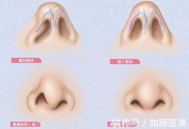 科普 鼻翼变窄整形手术如何做?多少钱?科普&价格,分享塑造美鼻的秘密!