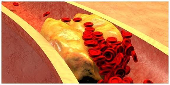 动脉硬化|血脂高不高,看脸就知道,若没有这3个症状,恭喜血脂控制得不错