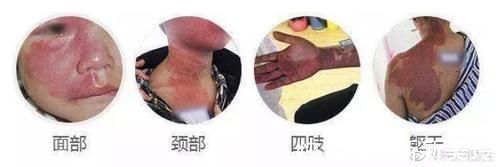 胎记|胎记需要治疗吗?医生告诉你,这些胎记不治疗真的不行!