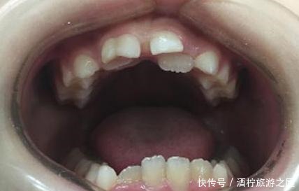 说道|7岁男孩乳牙未掉,恒牙又长,医生检查后说道幸亏来得及时