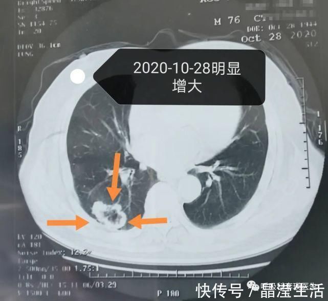 肺癌|肺癌的治疗要花多少钱?晚期肺癌还有必要治疗吗?
