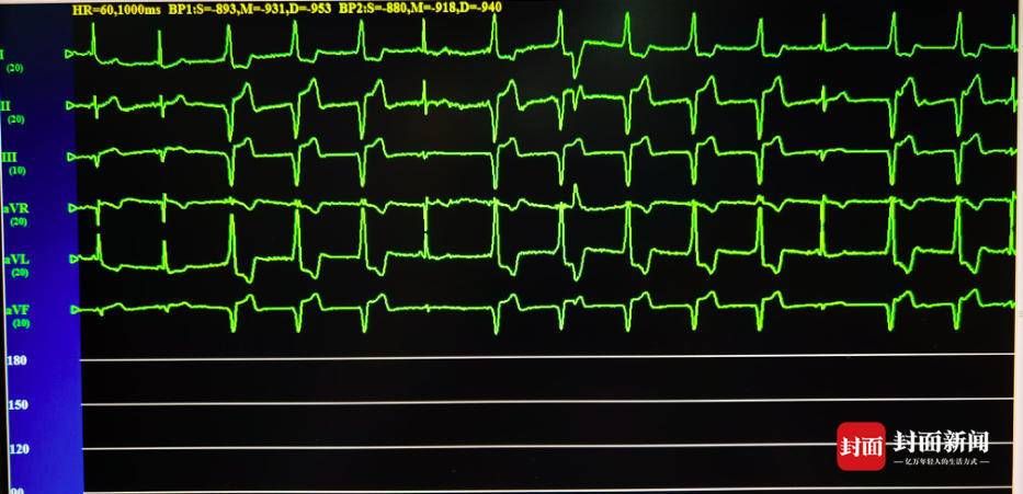 起搏器|刷新记录！四川泸州99岁超高龄患者成功植入心脏起搏器重获“心生”