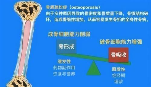 中成药|45岁女子每天坚持喝酸奶,骨质疏松入院,医生怒斥:这不是胡闹吗