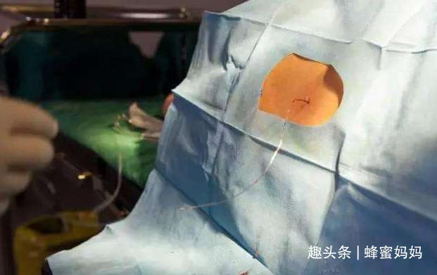 麻药|不打麻药“生剖”的剖腹产真实存在吗母爱的伟大,并非纸上谈兵