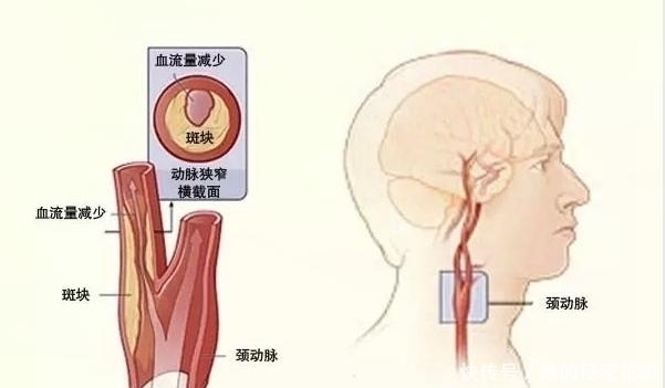 堵塞|颈动脉堵塞随时会引来脑梗,医生说:多吃2种蔬菜,对血管好处多