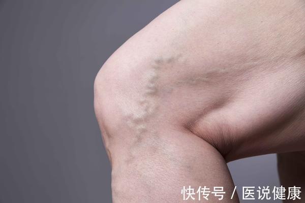 静脉|下肢出现这4种异常,当心静脉曲张已找上门,及时检查,别忽视