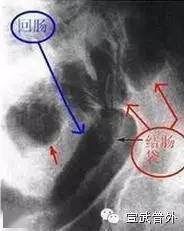 急诊科三天连收近10例，极度凶险！春节千万要警惕！