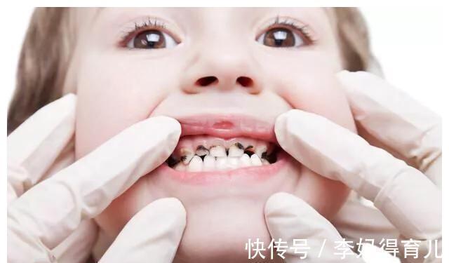 磨牙|窝沟封闭做一次可以保护一辈子?