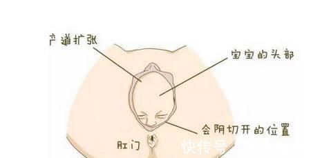 侧切|顺产也挨刀产后护理做好这7点,会阴侧切不再是噩梦