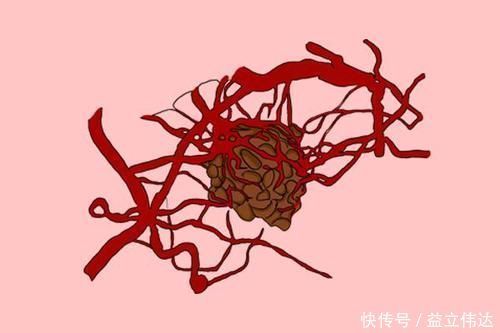 人体|查出癌症,就一定要手术切除?院士的肺腑之言,也许得听一听