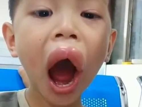 宝爸|熊孩子偷吃了一颗葡萄，嘴巴变成了香肠嘴，医生看了都憋笑