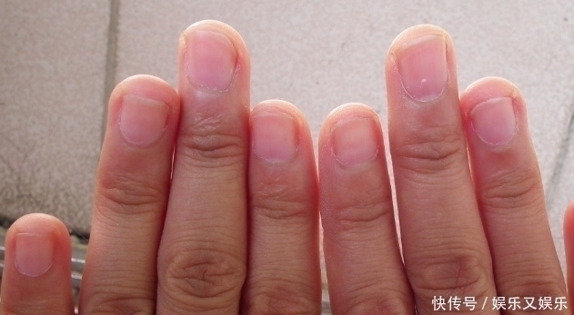 指甲上出现“竖纹”别自己瞎猜了,3个原因才是“元凶”