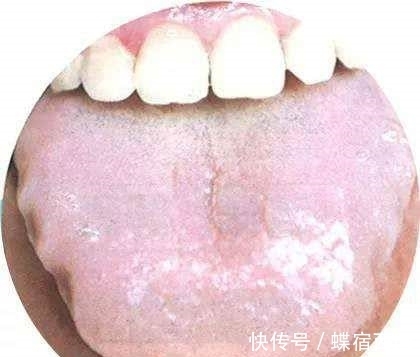 中医内科学|有冠心病的人,舌头有三种“凶相”!
