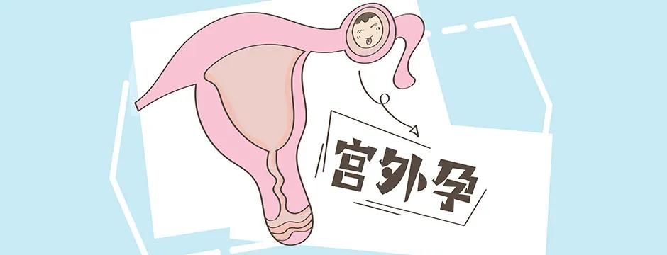 患者|宫外孕会来＂大姨妈＂吗？如何预防宫外孕？