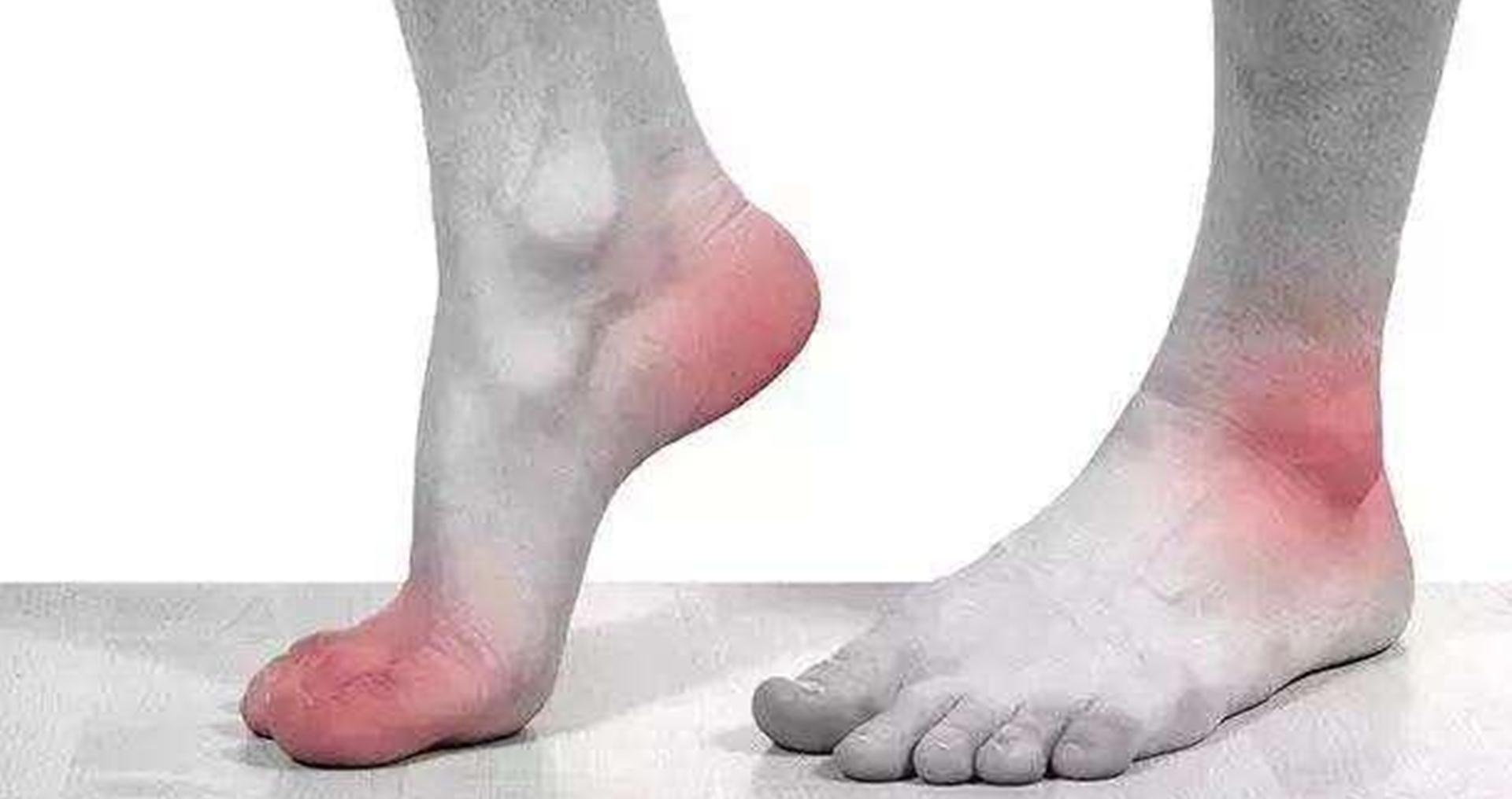 运动量|假如我们脚后跟痛,千万不要忍,可能与疾病相关