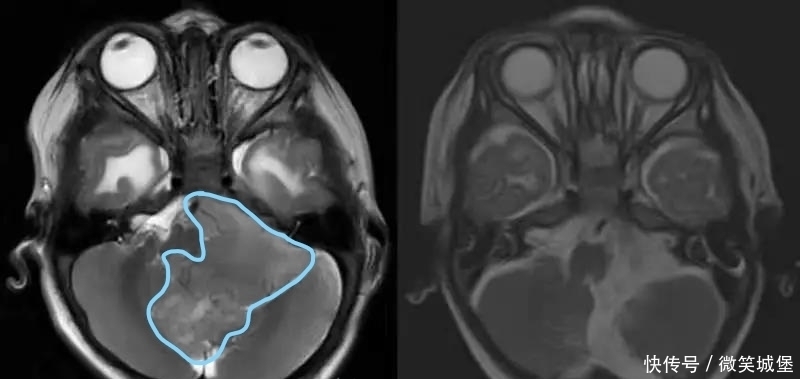 幼儿|11月大幼儿喝奶后多次呕吐,送进医后竟被查出肿瘤
