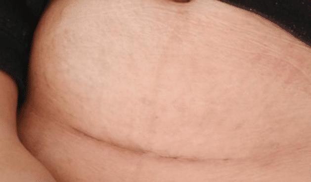 剖腹产|剖腹产多会有3个“后遗症”,二胎宝妈尤为明显,要格外注意