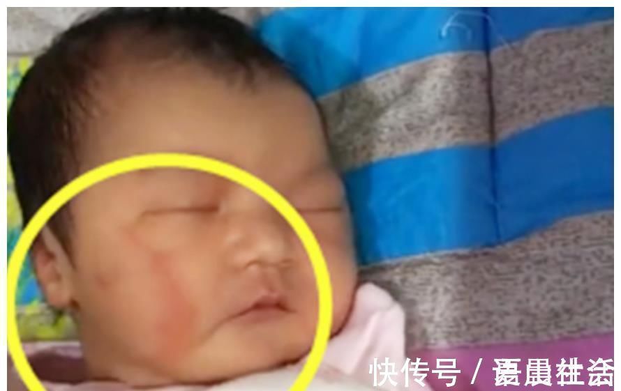 印记|宝宝脸上“产钳印”未消除，婆婆开启“责怪模式”，宝妈好心塞！