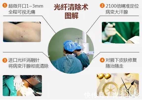 大汗腺清除术