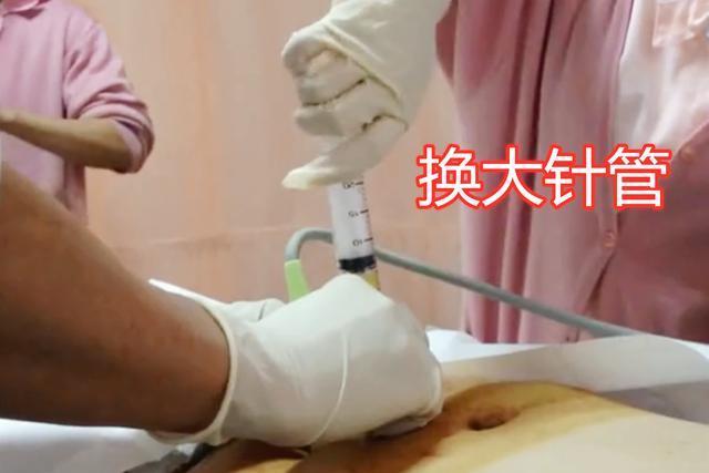 羊水穿刺|准妈妈做“羊水穿刺”现场,老公默默的喊加油,而妈妈已哭成泪人