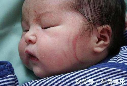 产钳|6个月宝宝产钳印明显,奶奶找医生“算账”,医生的话让她脸红