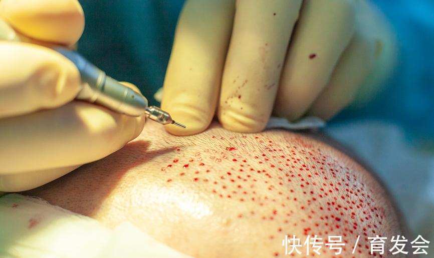 成活率 用植发生发,你要闯过这些难关,否则白费!