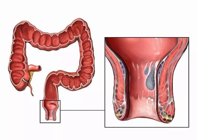 慢性胃炎|从炎症到癌症,警惕以下7种炎症成为癌症“帮凶”