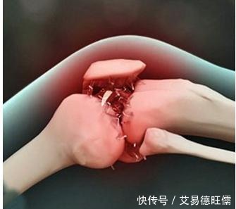 到底|膝关节总是“咔咔”的响,到底是怎么回事?