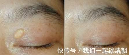 血脂|高血脂“祸根”被揪出,不是肥肉,此物天天吃,血液会“浓如粥”