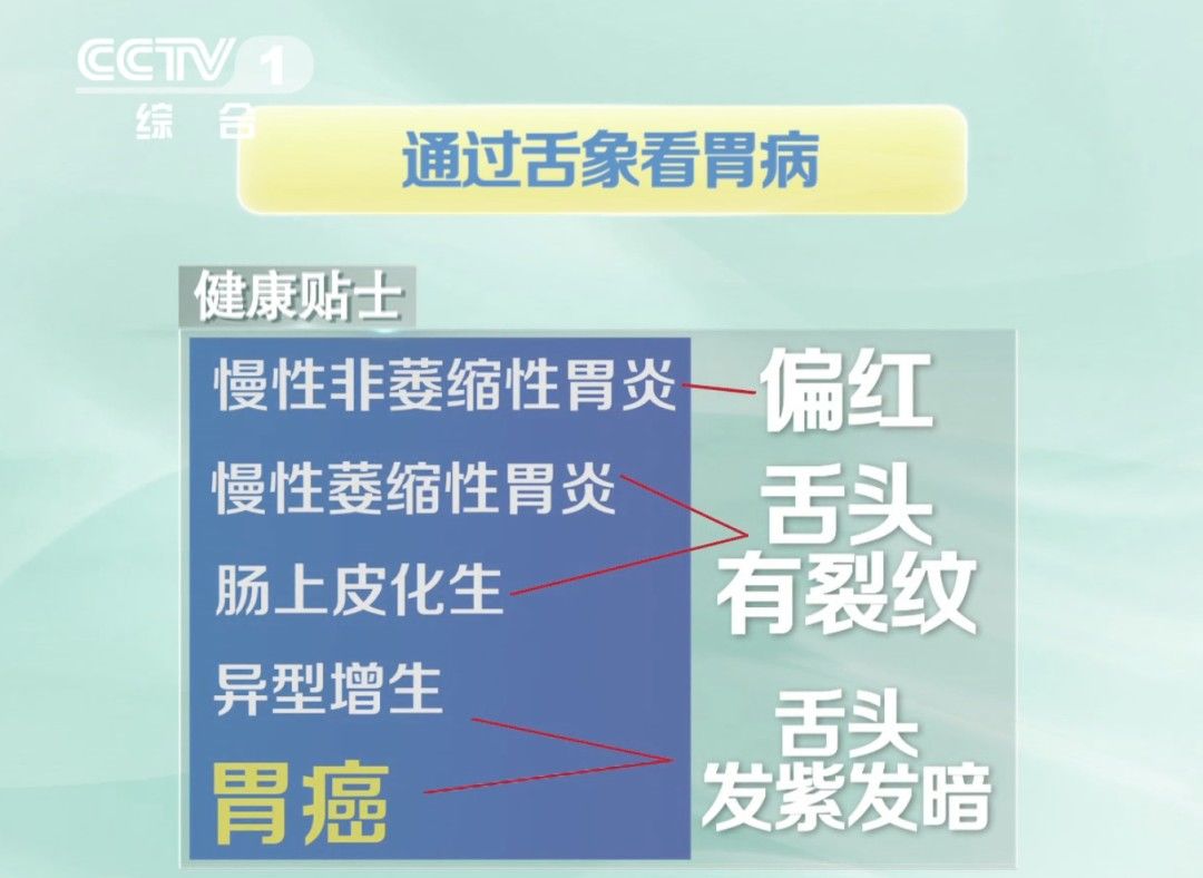 是真的吗|从胃炎到胃癌只需4步！控制它是早期最有力的阻断方法