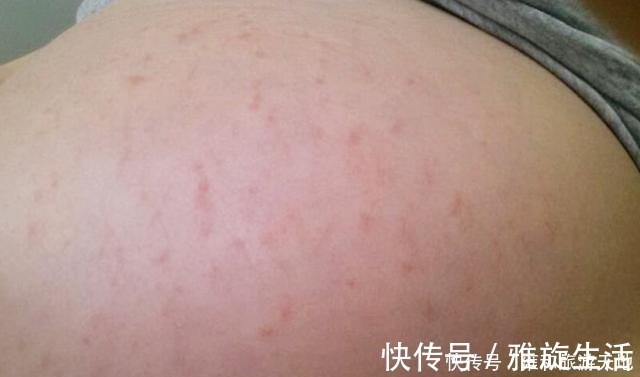 黑线|在怀孕后,女性皮肤上的变化较为明显,这五点看看你有没有中招