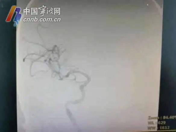 心脑血管|注意！夏天这个行为易导致脑梗死，宁波一医院近半月收治了16例