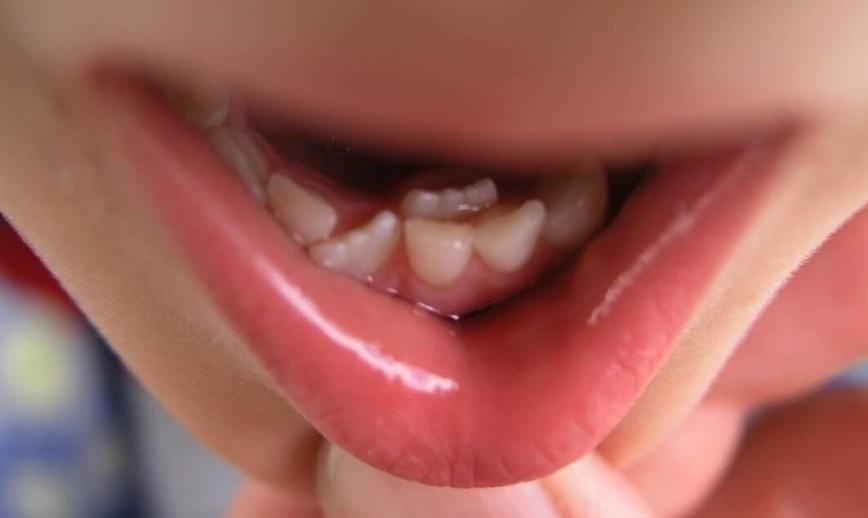 宝宝|4岁孩子一嘴黑牙,妈妈毫不在意认为牙齿能换,牙医叹气无知