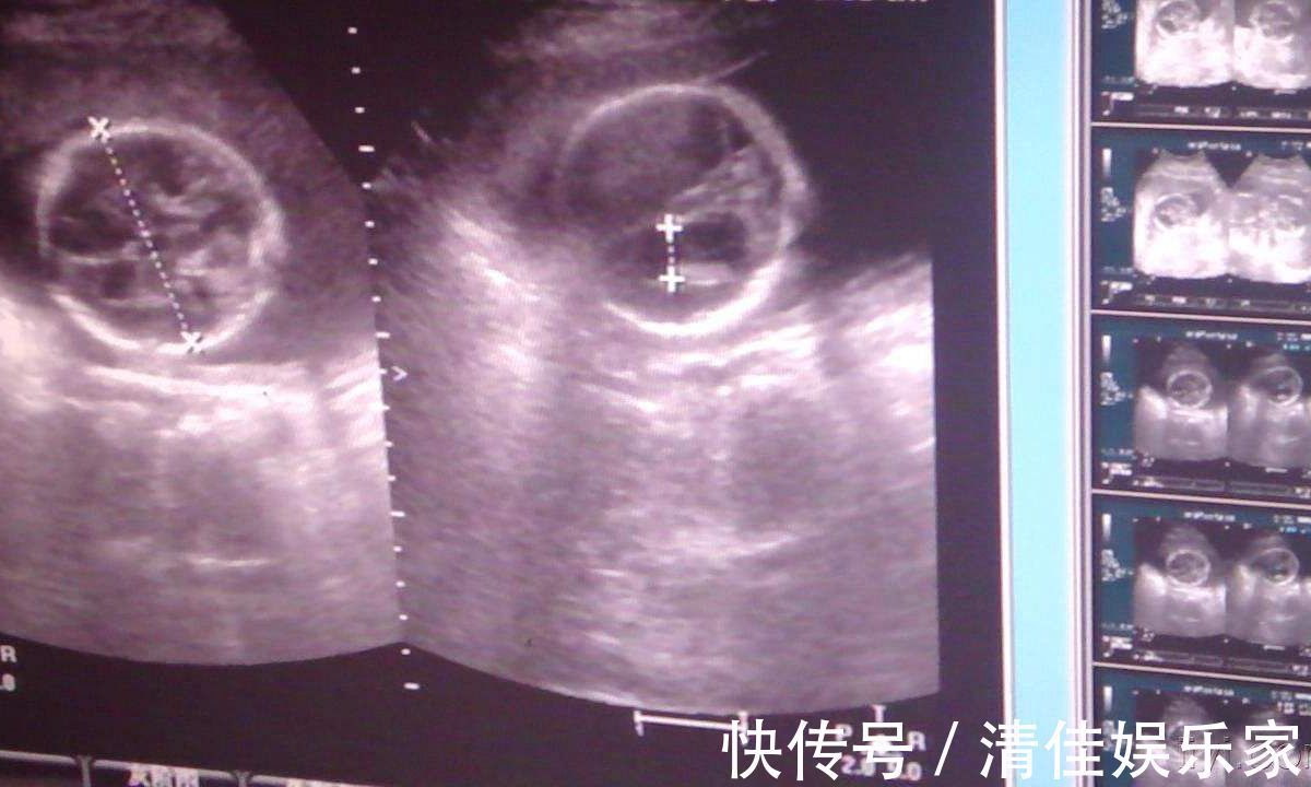 排泄物|胎儿在母亲肚子里，生活的很“精致”！不过他的大小便都去哪了