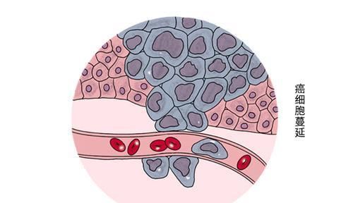 肿瘤不等于癌症，两者到底有什么区别看完就安心了